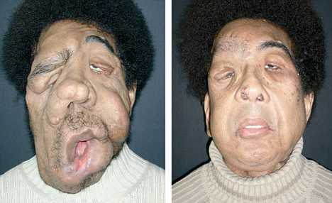 rare-facial-tumor_1